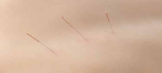 Akupunktur – die große Macht der kleinen Nadeln
