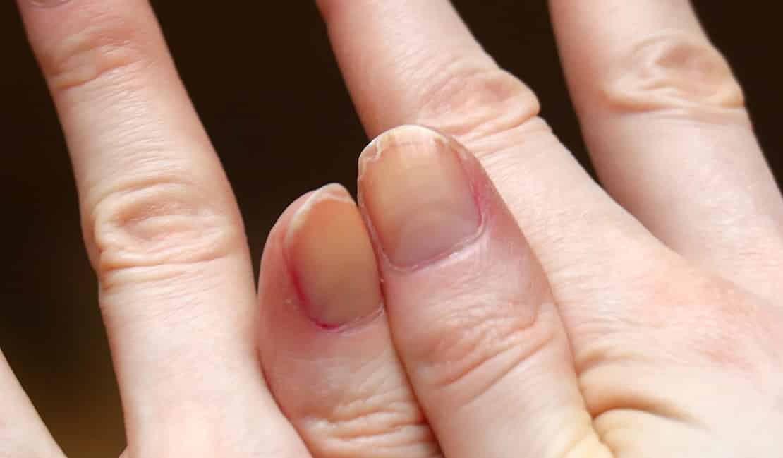 Brüchige Fingernägel und was dagegen hilft
